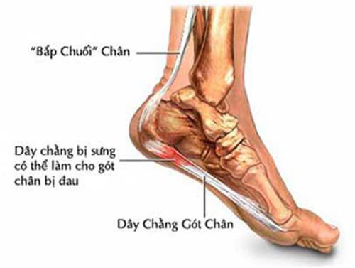 Nguyên nhân gây đau gót chân