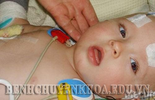 Bệnh xuất huyết não ở trẻ sơ sinh thiếu vitamin K