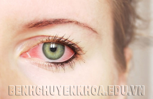 Nguyên nhân, triệu chứng và cách điều trị đau mắt đỏ