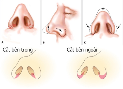 Phẫu thuật nâng mũi phụ thuộc vào nhiều yếu tố