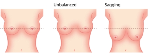Nâng ngực chảy xệ nội soi an toàn hơn