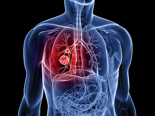 Thường xuyên bị nhiễm trùng là dấu hiệu cảnh báo bệnh ung thư phổi gia đoạn đầu