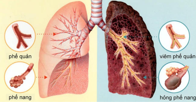 dấu hiệu bệnh ung thư phổi gia đoạn đầu