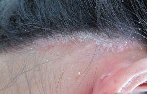 Nấm da đầu là căn bệnh khá nguy hiểm và thường gặp ở cả nam và nữ giới