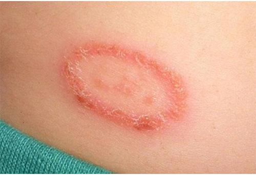 Điều trị bệnh eczema để kiểm soát các cơn ngứa, giảm các biểu hiện viêm da...