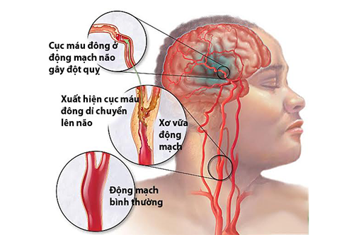 Những triệu chứng thường gặp của bệnh tai biến mạch máu não là gì?