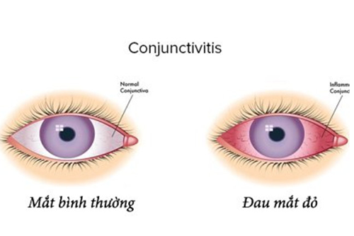 Dược sĩ cho biết những dấu hiệu và cách điều trị đau mắt đỏ tốt nhất