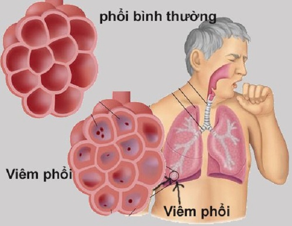 Triệu chứng của bệnh viêm phổi
