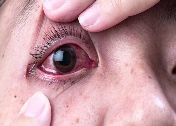 Cách chữa bệnh đau mắt đỏ